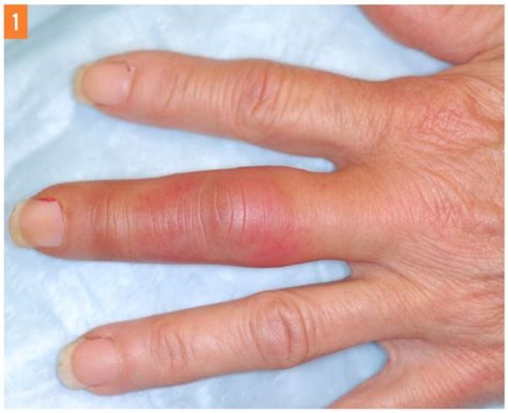 What does a swollen index finger mean?