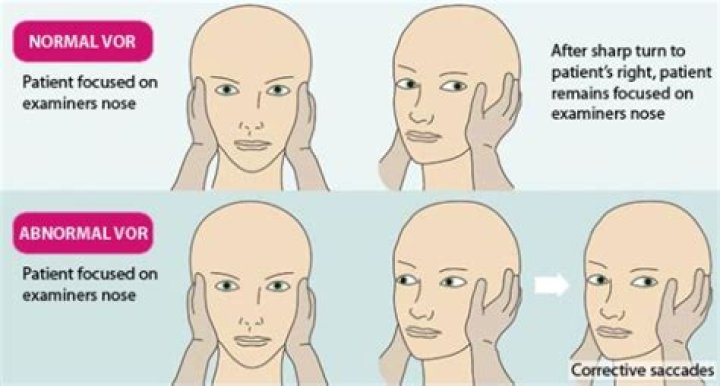 What does abnormal VOR mean?