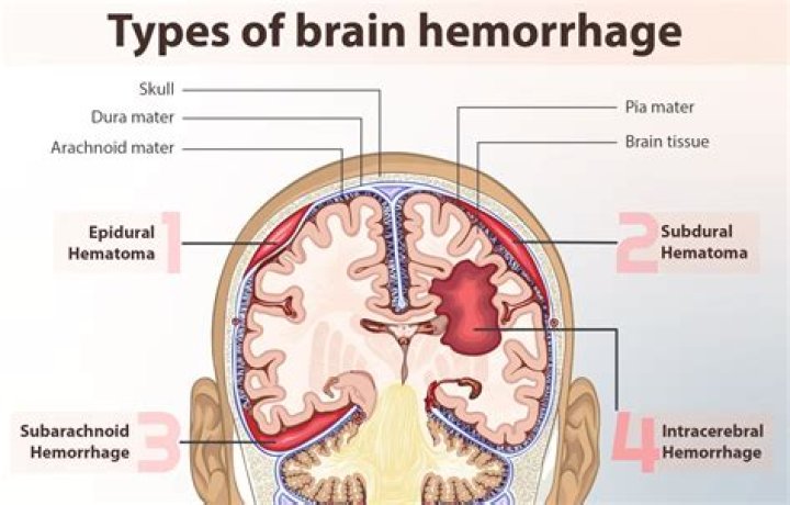 What does an epidural hematoma look like?