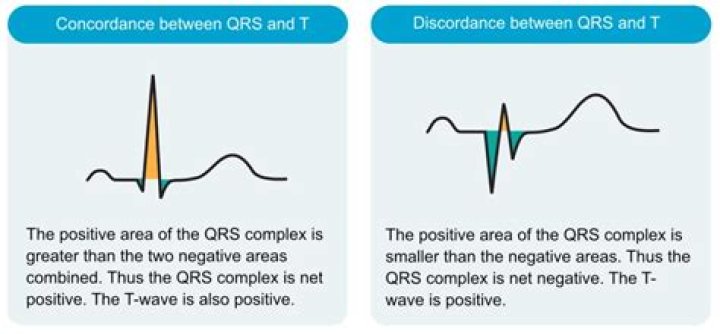 What does concordant pain mean?