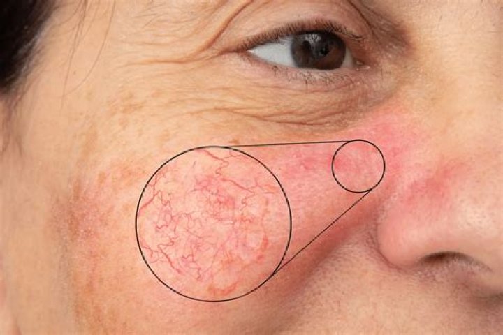 What does couperose skin look like?