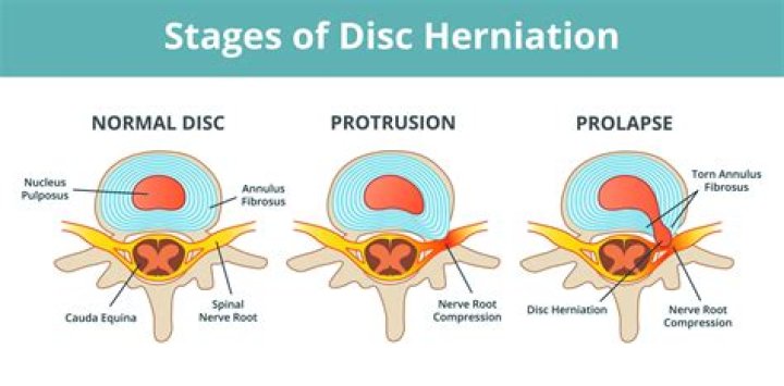What does disc protrusions mean?