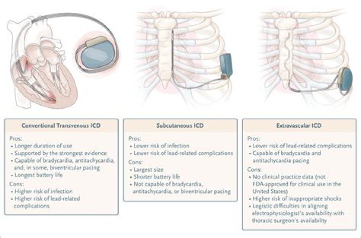 What does ICD stand for in cardiology?