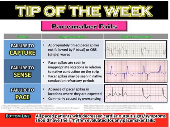What does it mean when a pacemaker fails to capture?
