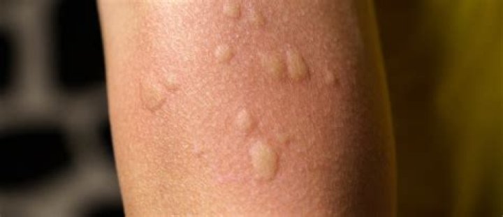 What does it mean when you have welts all over your body?