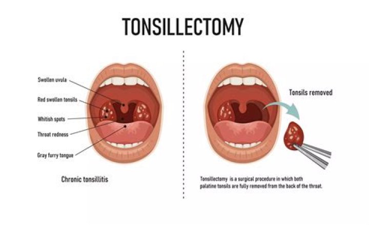 What does it mean when your tonsil bleeds?