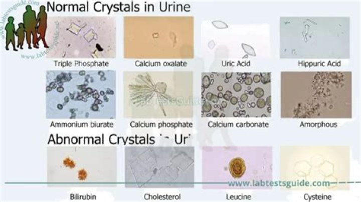 What does it mean when your urine test is abnormal?