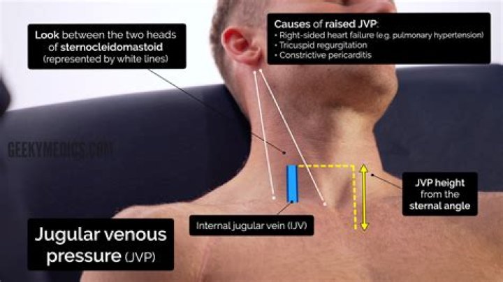 What does JVP correlate with?