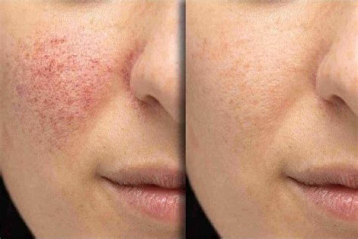 What does laser Genesis do for your skin?