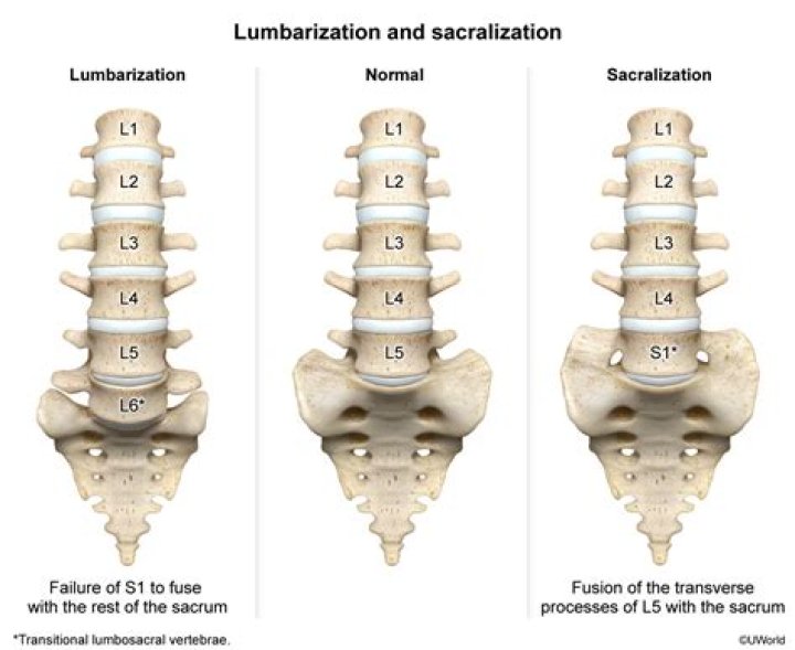 What does Lumbarisation of S1 mean?