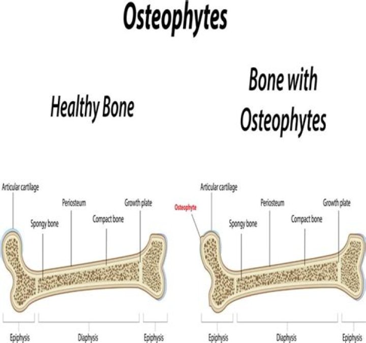 What does prominent osteophytes mean?