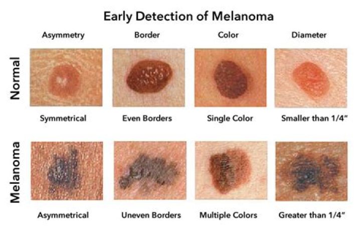 What does red melanoma look like?