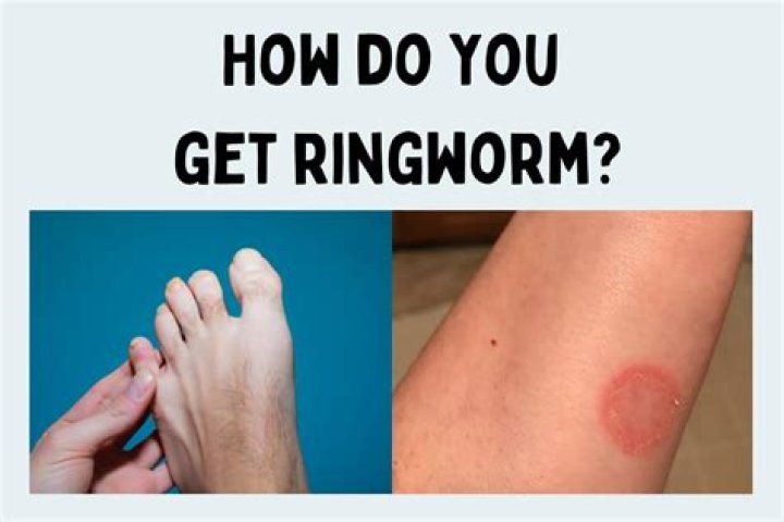 What does ringworm on your feet look like?