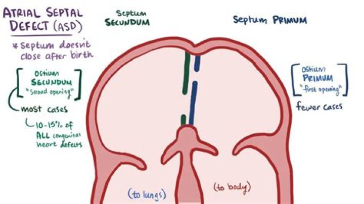 What does secundum ASD mean?