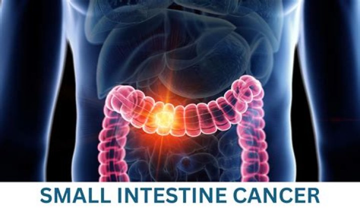 What does small intestine cancer feel like?