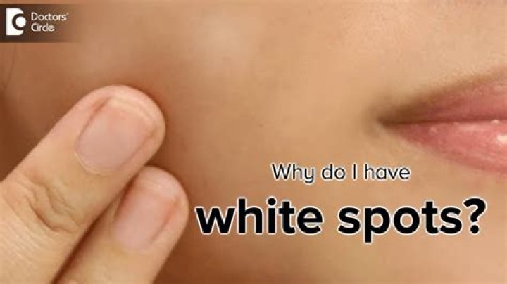 What does white spots on neck mean?