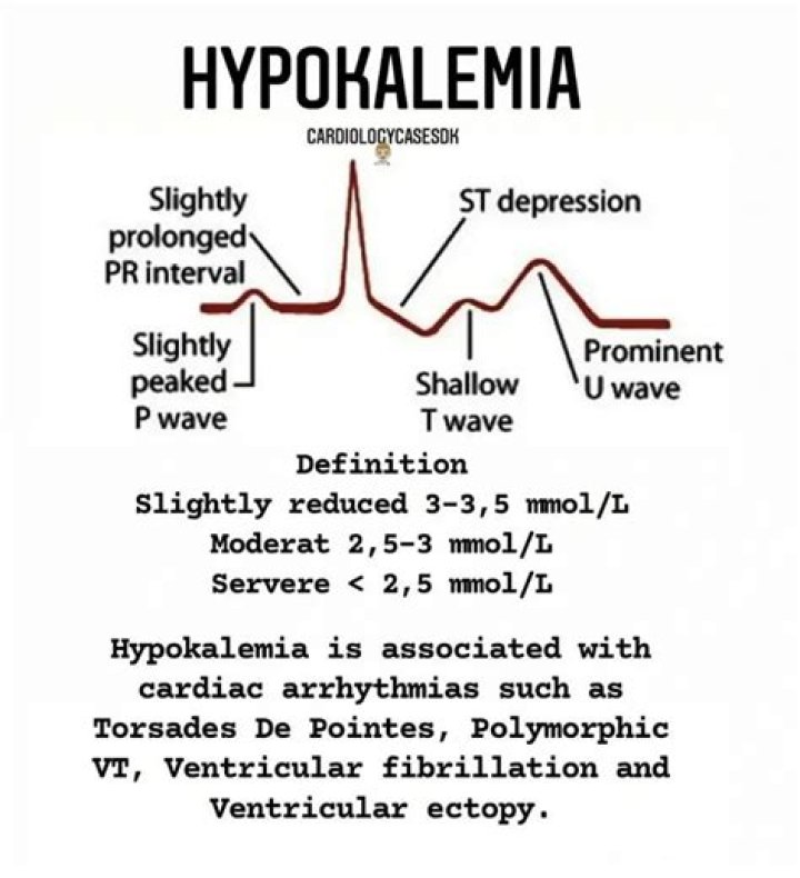 What effect does hypokalemia have on cardiac function?