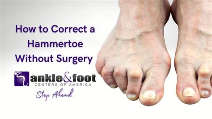 What exercises can I do to correct hammer toes?