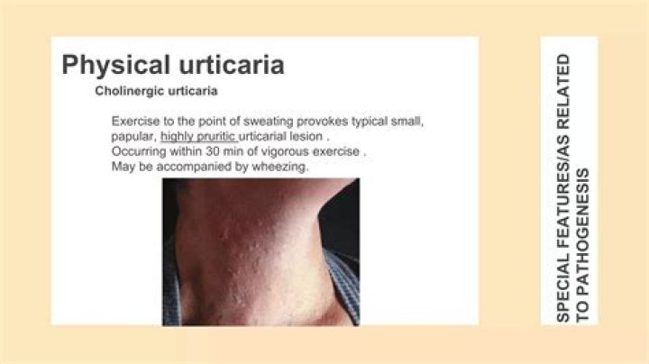 What foods cause exercise induced urticaria?