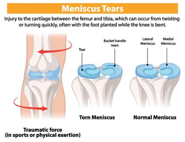 What force causes a meniscus tear?