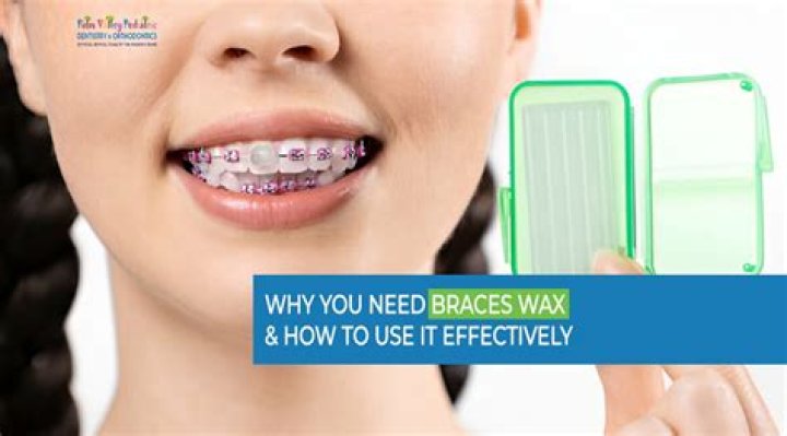 What glue do dentists use for braces?