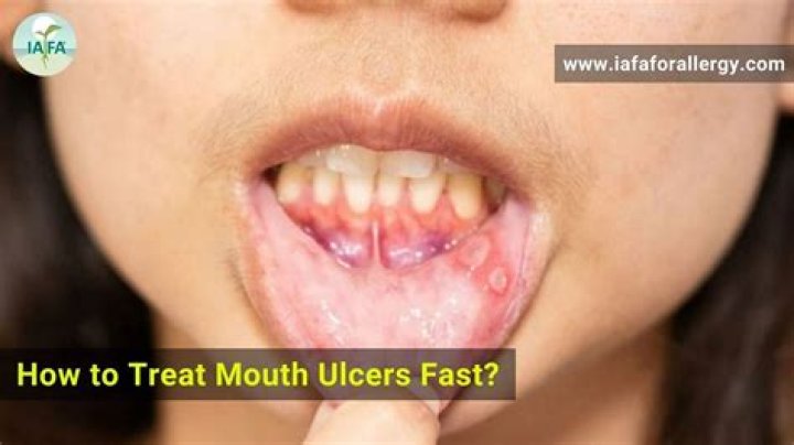 What happens if a mouth ulcer is left untreated?