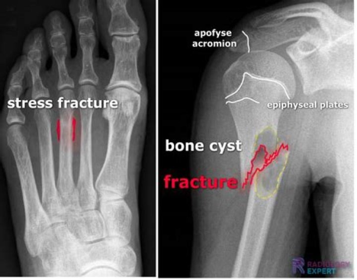 What happens if you run on a hairline fracture?