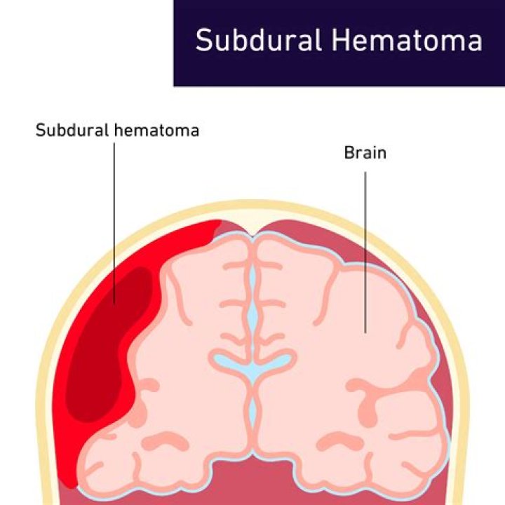 What happens to the brain after a subdural hematoma?