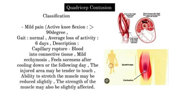 What happens to the muscle compartment following quadriceps contusion?