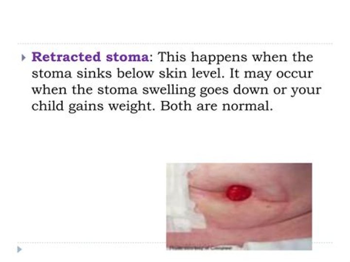 What happens when a stoma fails?