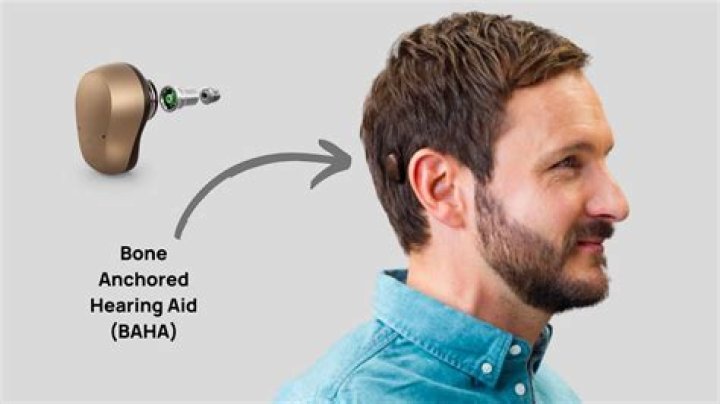 What hearing aid is best for conductive loss?