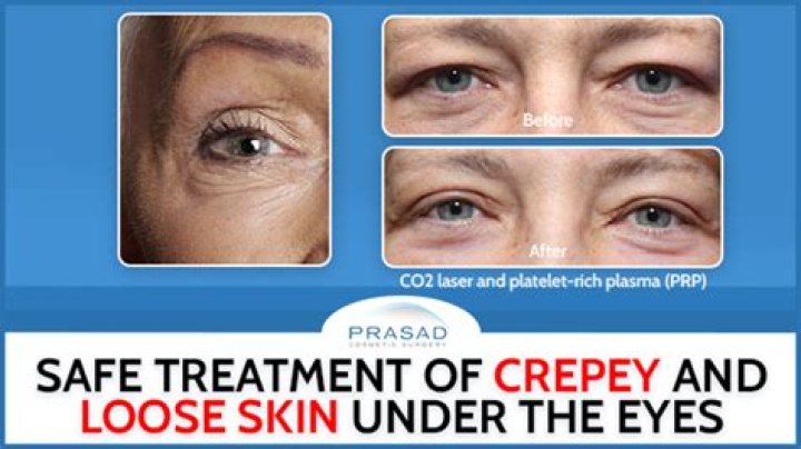 What helps crepey skin under eyes?