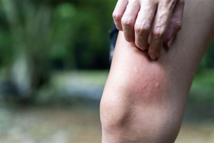 What insect bites can cause bruising?