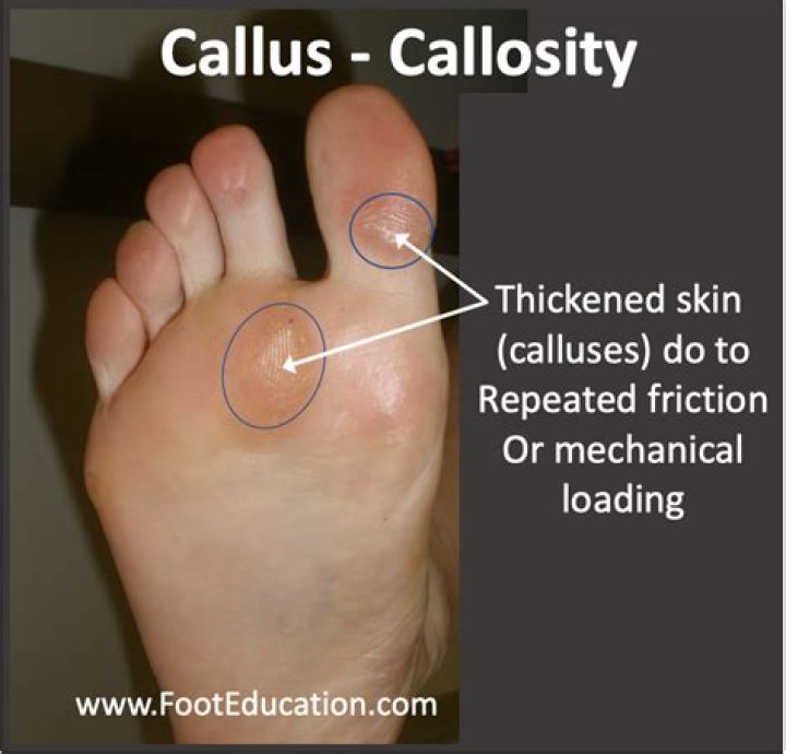 What is a callous personality?