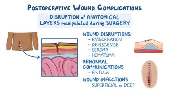 What is a common postoperative complication of anesthesia?