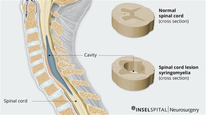 What is a congenitally small spinal canal?