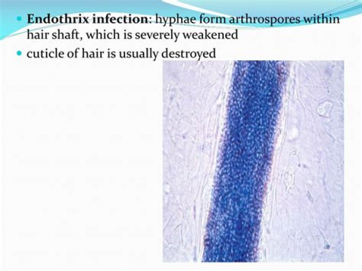 What is a Endothrix infection?