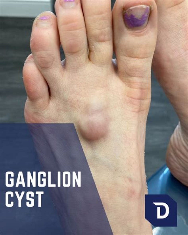 What is a ganglion cyst on top of foot?