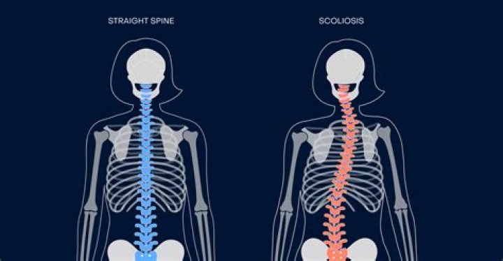What is a good job for someone with scoliosis?