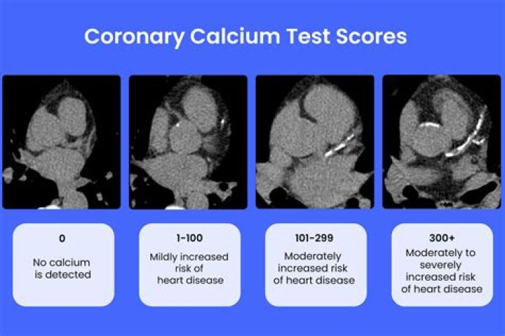 What is a good total coronary calcium score?