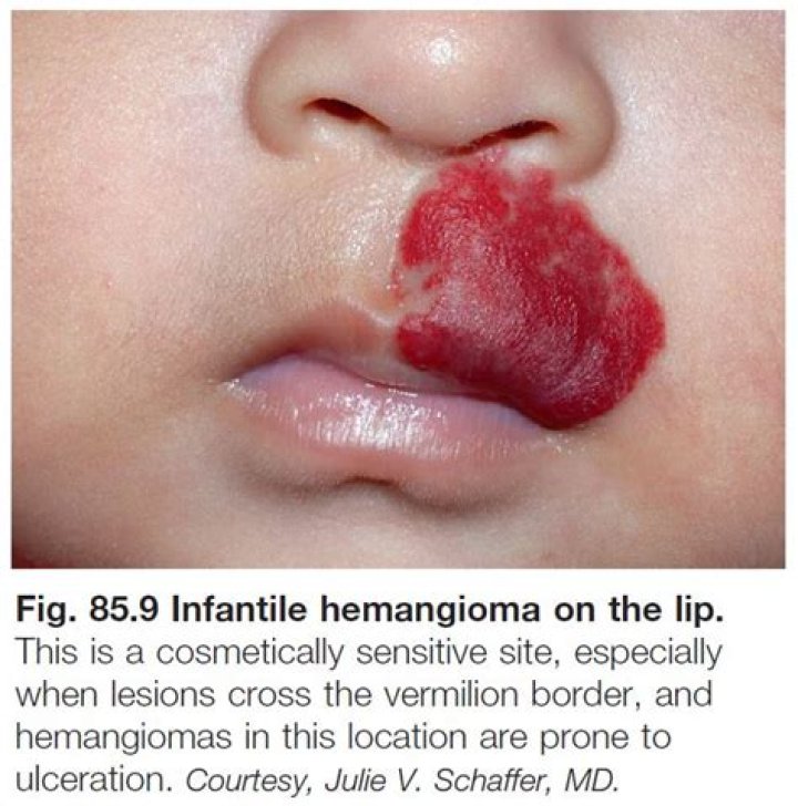 What is a hemangioma on the lip?