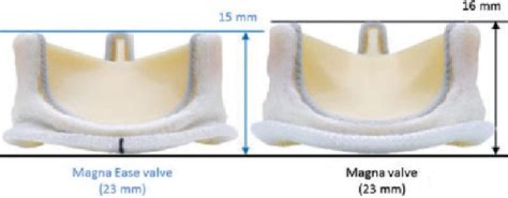 What is a Magna Ease pericardial valve?