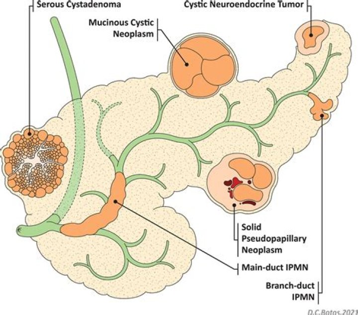 What is a mucinous neoplasm of the pancreas?