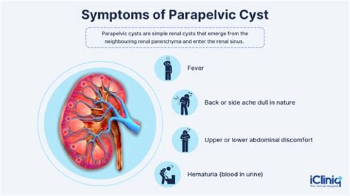 What is a Parapelvic cyst in the kidney?