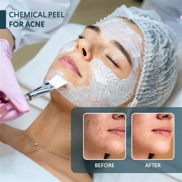 What is a peeling cream?