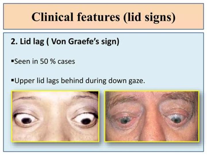 What is a positive lid lag sign?