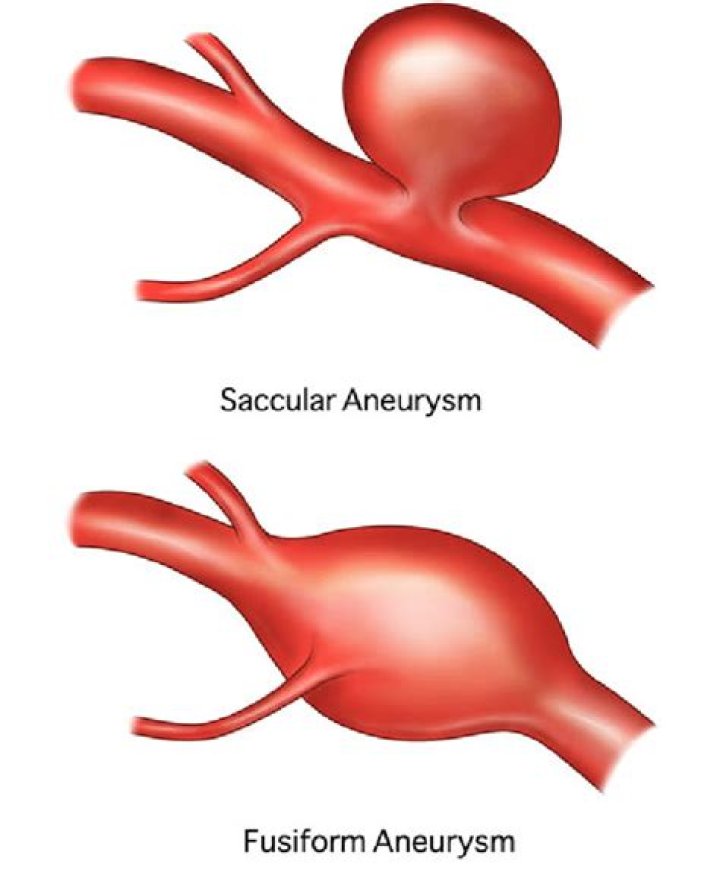 What is a saccular aortic aneurysm?