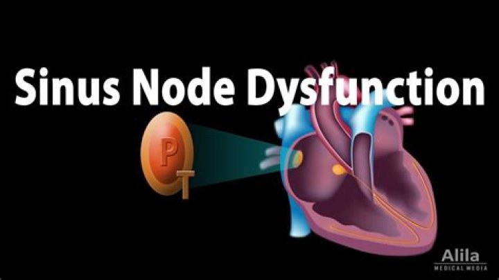 What is a sinus node dysfunction?