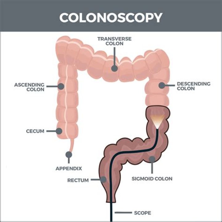 What is a sluggish colon?