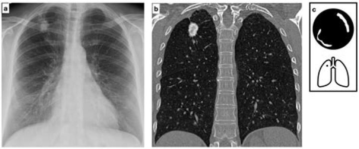 What is a Spiculated pulmonary nodule?
